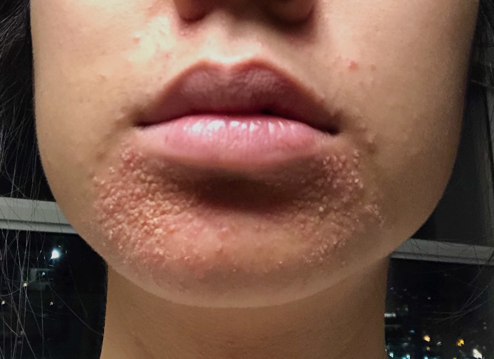 Perioral Dermatitis Explained