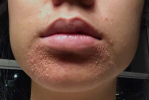 Perioral dermatitis, lip rash